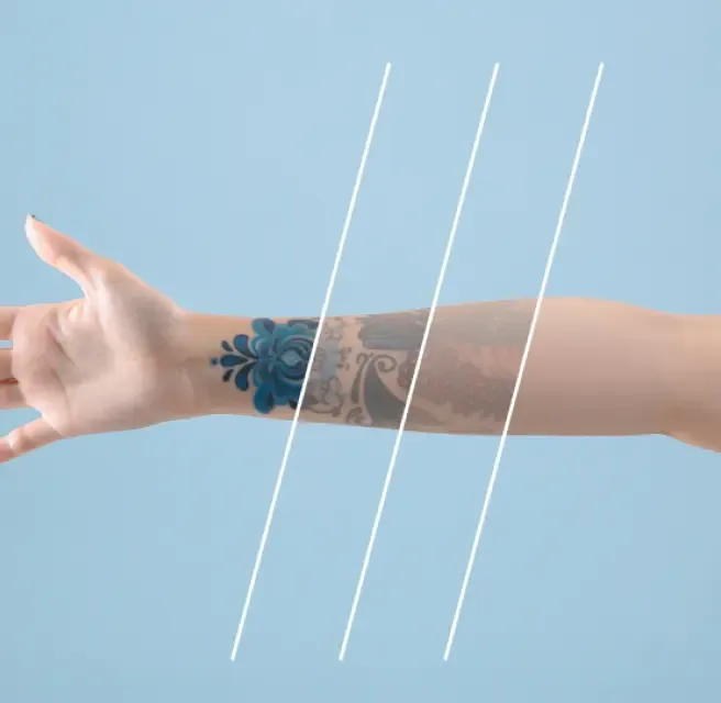 Forearm and wrist tattoo fading in stages across laser sessions
