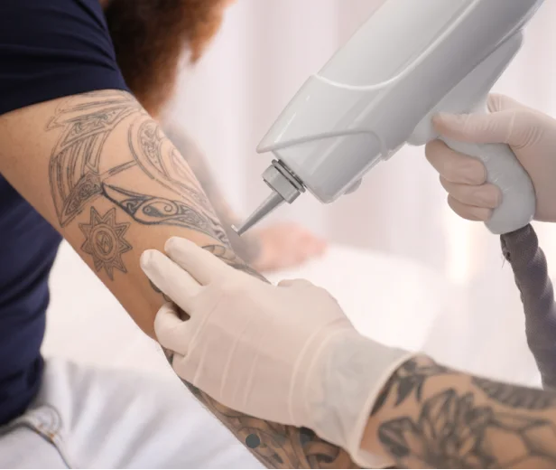 laser tattoo removal Clark NJ