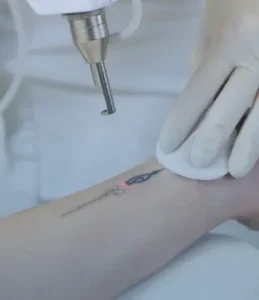 laser tattoo removal Clark NJ